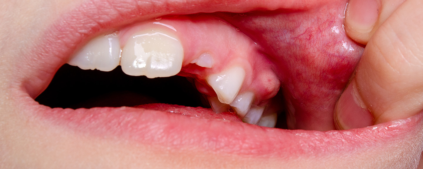 歯ぐきの病気